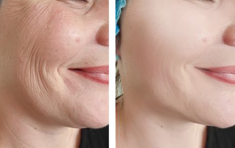 Antes e depois de procedimento de rejuvenescimento facial