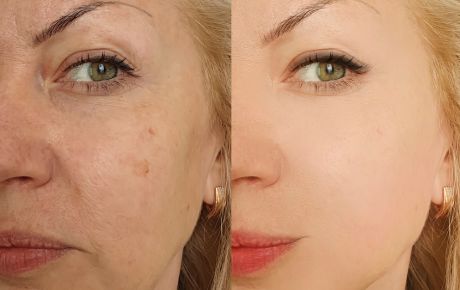 Antes e depois de procedimento de rejuvenescimento facial