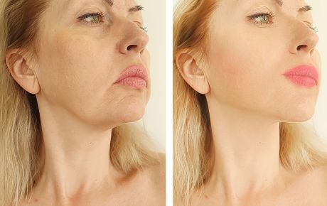 Antes e depois de procedimento de rejuvenescimento facial