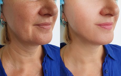 Antes e depois de procedimento de rejuvenescimento facial