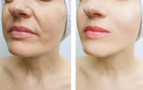 Antes e depois de procedimento de rejuvenescimento facial