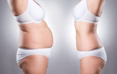 Antes e depois de redução de medidas
